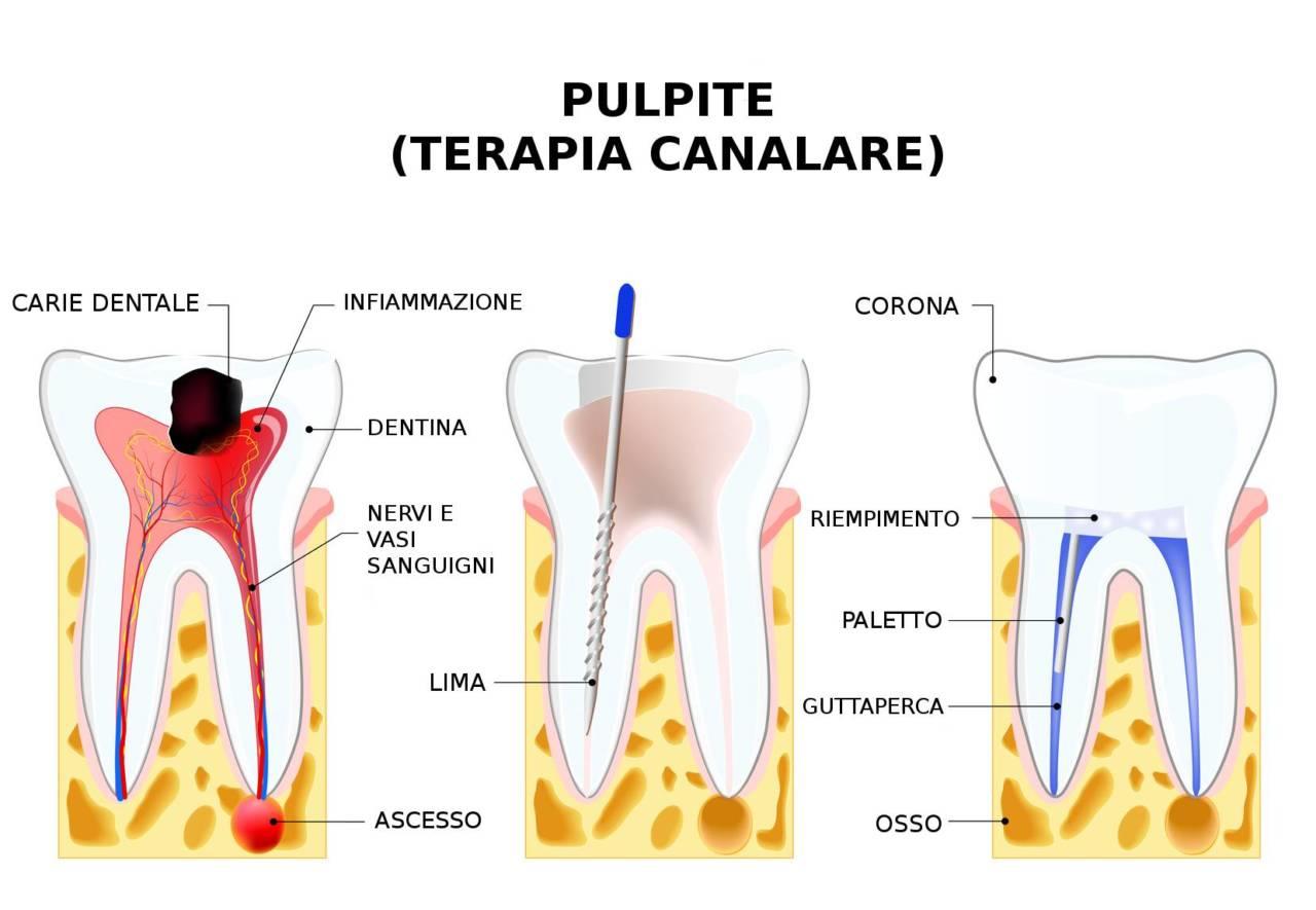 Endodonzia Endodonzia