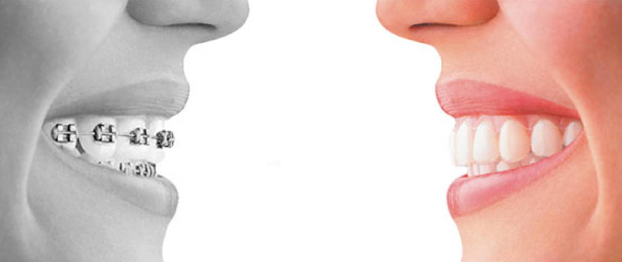 Open Day Apparecchio Invisibile Open Day Apparecchio Invisibile