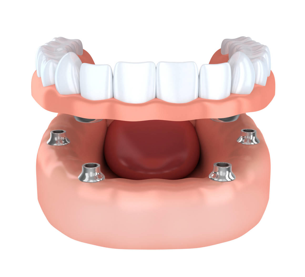 Tooth implantation, denture
