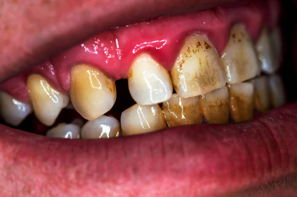 Smoker's,Teeth.,Plaque.,Dental,Calculus.,Close-up.,Disease,Of,The,Teeth.