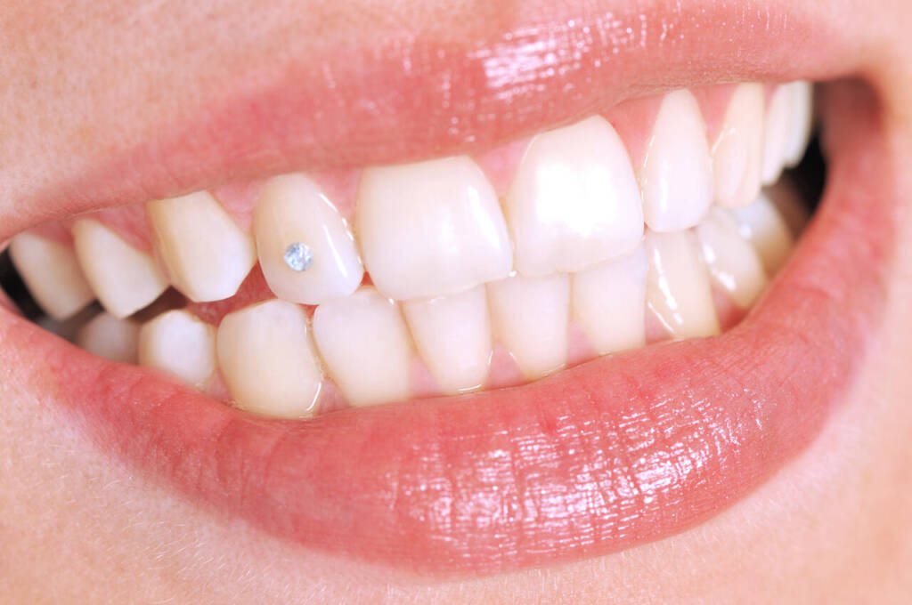 Close-up,Of,Patient,S,Open,Mouth,With,A,Diamond,Tooth